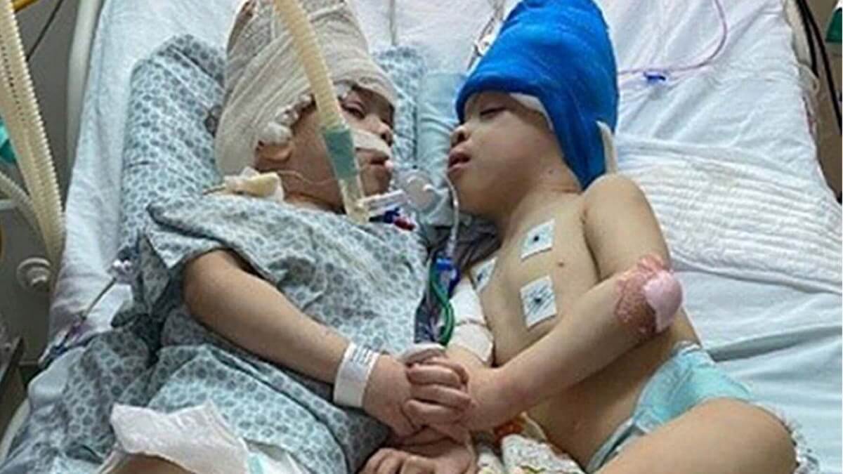 pa media conjoined twins after surgery